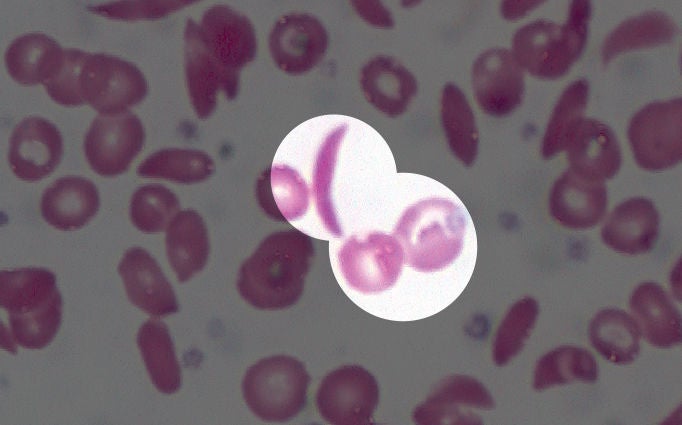 Image of sickle blood cells