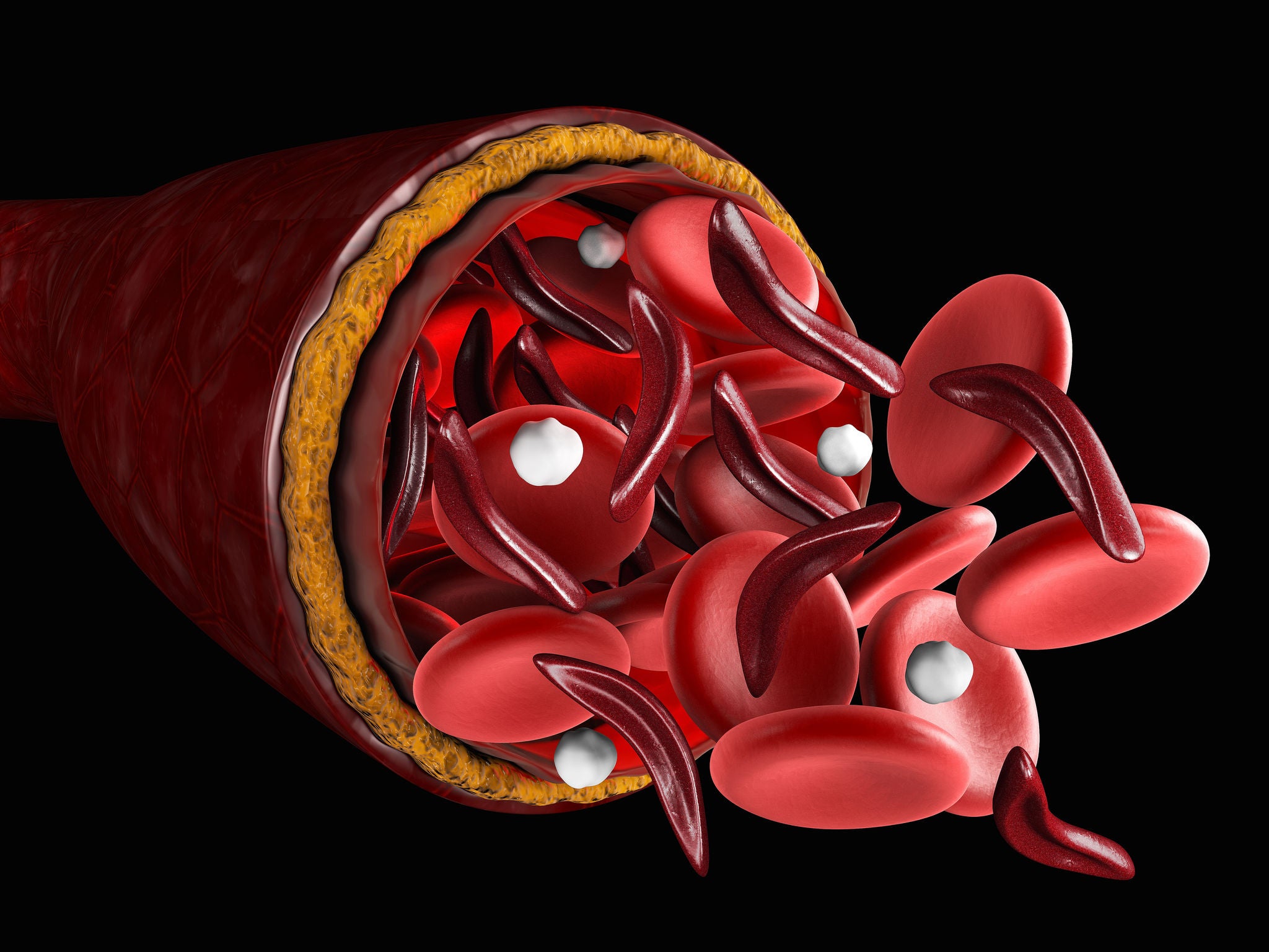 The difference of Normal red blood cell and sickle cell, 3d Illustration about medical.